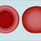Thumbnail voor 'Hereditaire sferocytose'